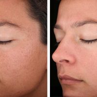 BioRePeelCl3 Chemical Peel