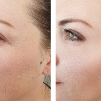 Facial