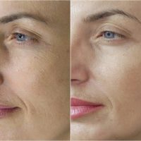 Microneedling