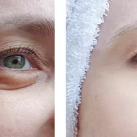 Polynucleotide Under Eye Treatment before and after