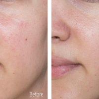Skin Boosters